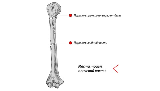 Перелом плечевой кости