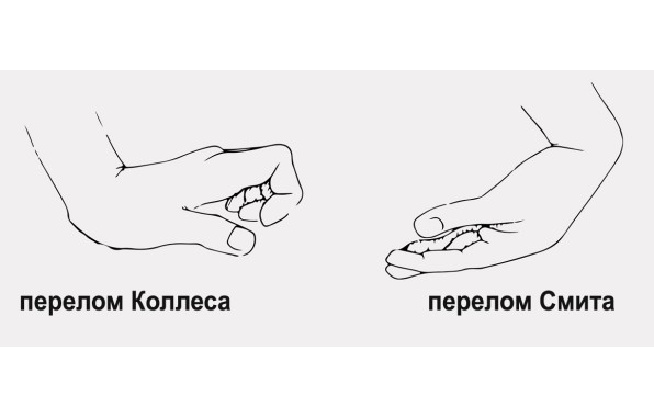 Перелом запястья