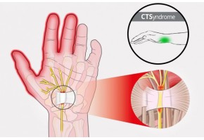 Система запястных туннелей - CTSyndrome