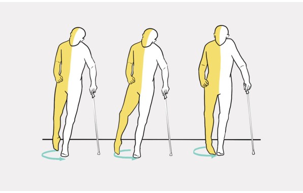 Свисающая стопа 