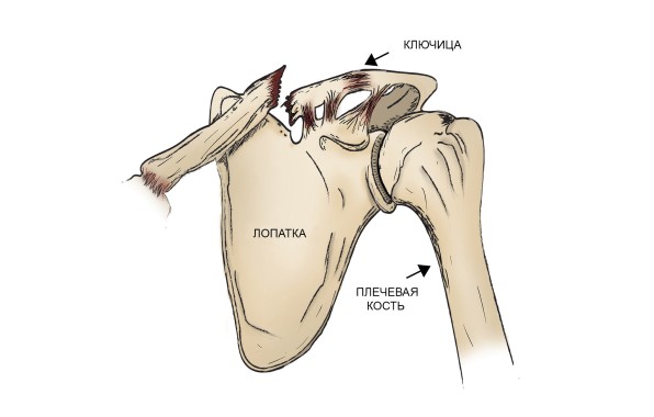 Поднадкостничный перелом
