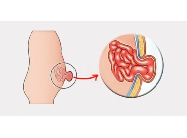 Грыжа брюшной полости