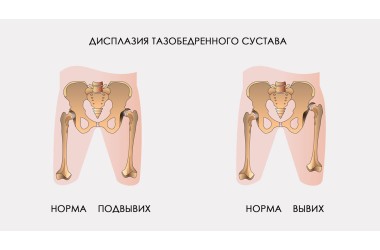 Дисплазия и вывих тазобедренного сустава