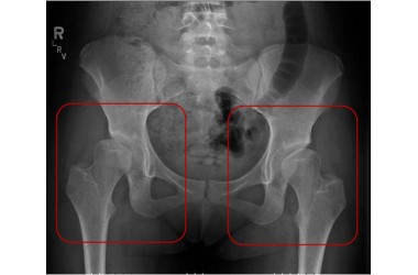 Здоровые тазобедренные суставы женщины преклонного возраста