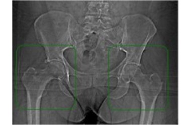 Двухсторонняя дисплазия у 29-летней женщины.