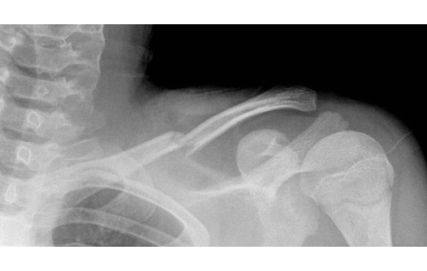 Перелом ключицы 