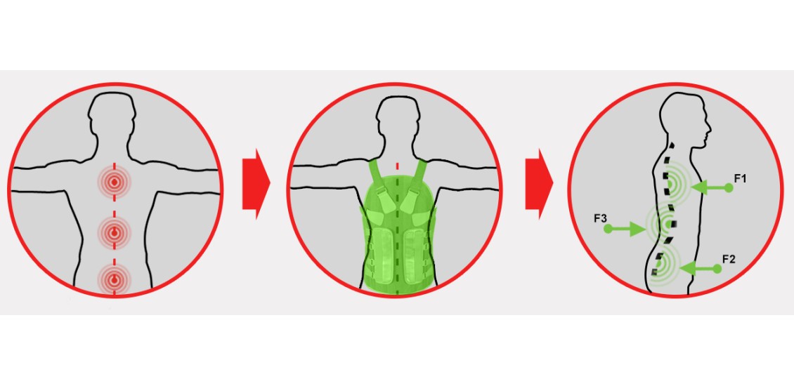 Ортез TLSO образует 3-точечное распределение усилий