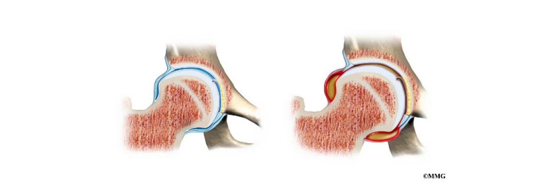 ЮНОШЕСКИЙ РЕВМАТОИДНЫЙ АРТРИТ