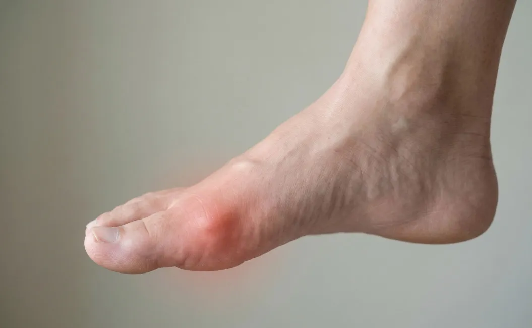 Подагра: полный гид по причинам, симптомам и лечению