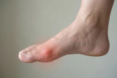 Подагра: не просто «болезнь королей», а серьезное заболевание. Полный гид по причинам, симптомам и лечению