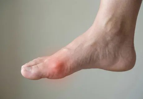 Подагра: не просто «болезнь королей», а серьезное заболевание. Полный гид по причинам, симптомам и лечению