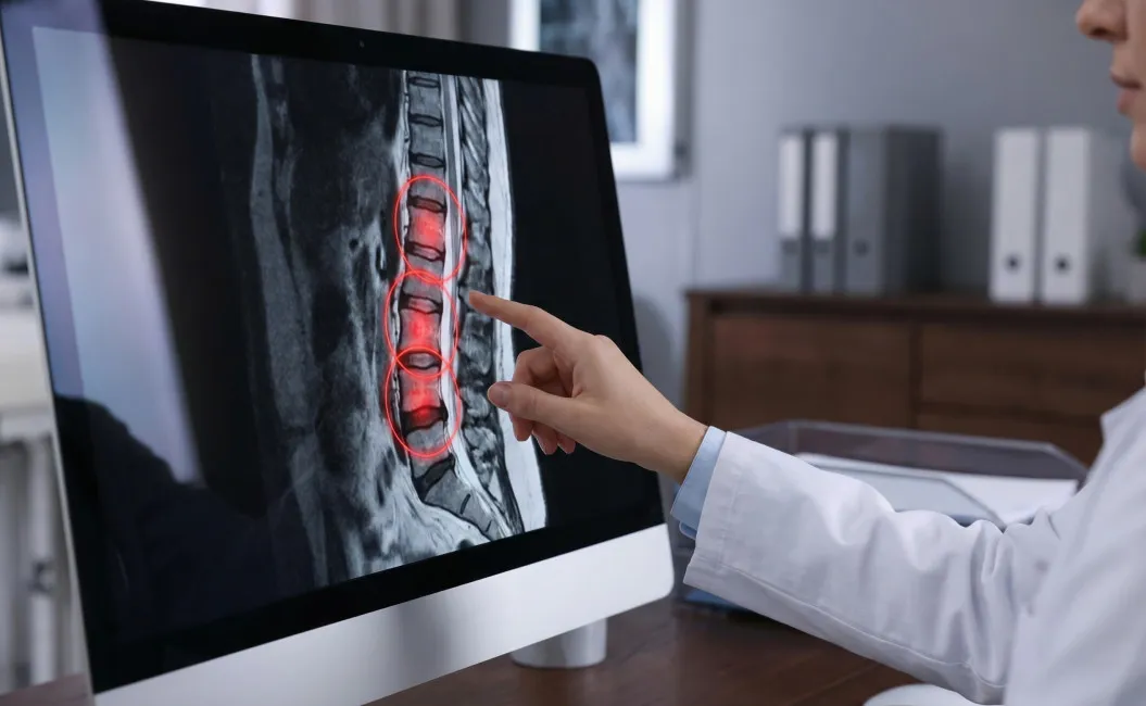 Спондилит: когда боль в спине говорит о серьезном заболевании